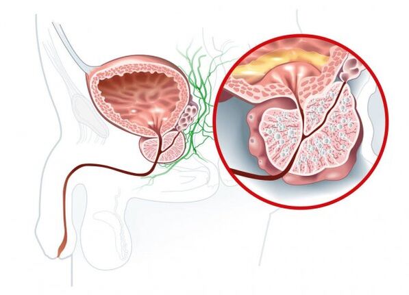 Triệu chứng viêm tuyến tiền liệt