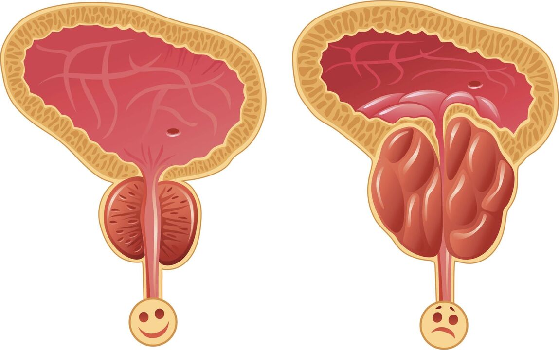 nguyên nhân phát triển viêm tuyến tiền liệt