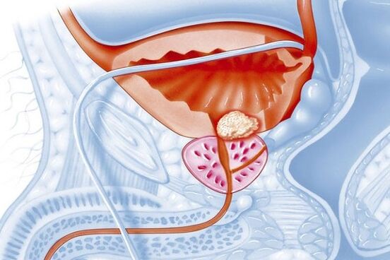 Quá trình viêm ở tuyến tiền liệt