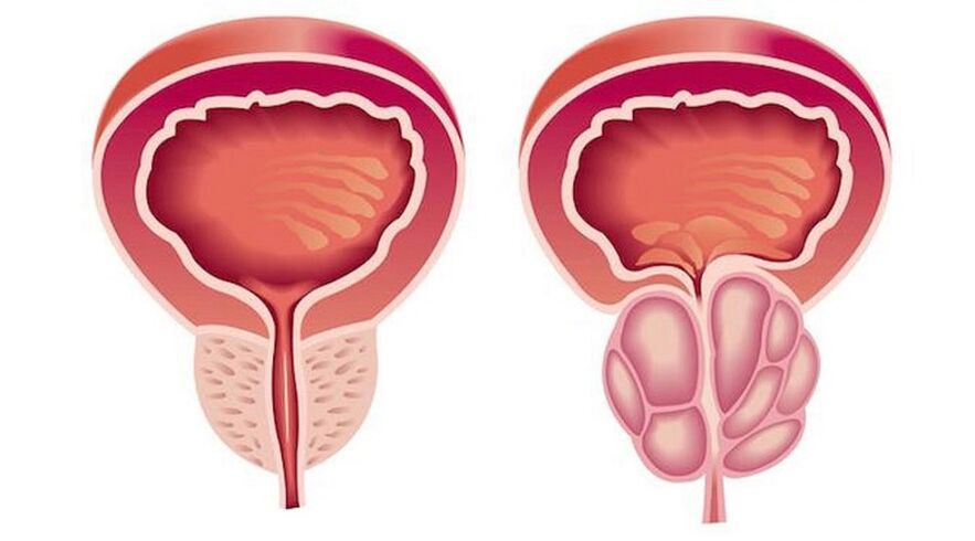 Tuyến tiền liệt khỏe mạnh và viêm