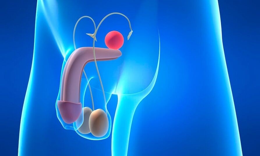 phù tuyến tiền liệt bị viêm tuyến tiền liệt