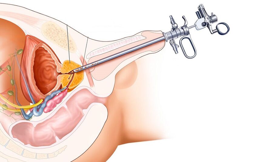 Điều trị phẫu thuật viêm tuyến tiền liệt
