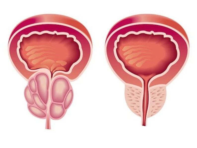 Viêm tuyến tiền liệt trông như thế nào